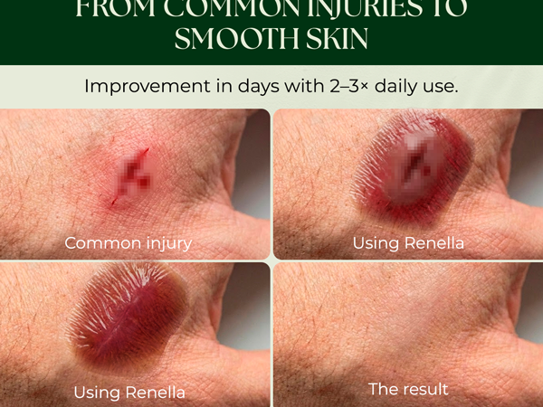 Natural Wound Care & Burn Gel - First Aid for Skin Recovery