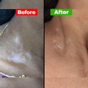 siya-ayurveda-psoriasis-treatment-oil-fo-5.jpg