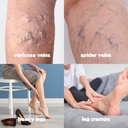 hillvital-varicose-veins-treatment-for-l-3.jpg