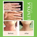 natural-eczema-cream-itch-relief-for-ato-4.jpg