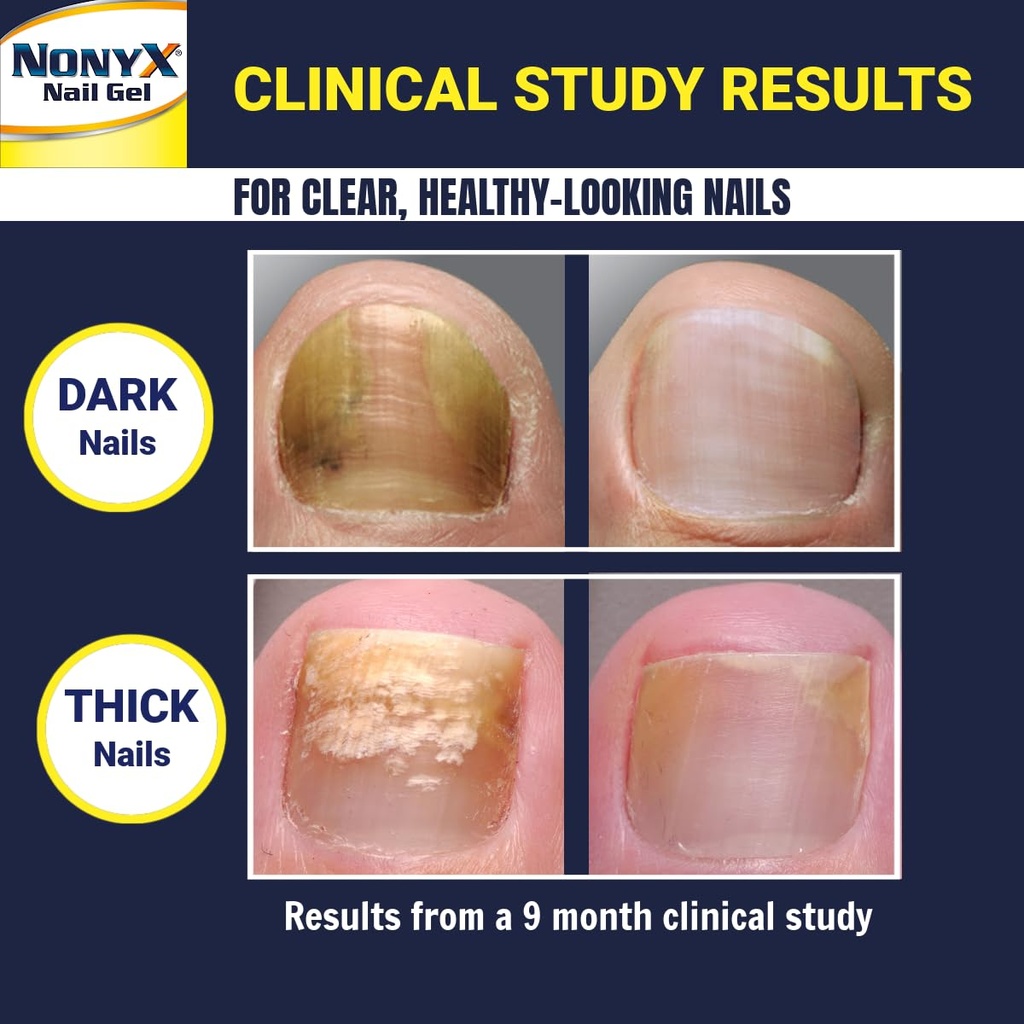 nonyx-fungal-nail-clarifying-gel-clinica-4.jpg