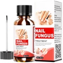 Toenail Fungus Treatment Extra Strength, Nail Fungus Treatment for Toenail, Natural Plant Extracts Toe Nail Fungus Treatments for Athletes Foot